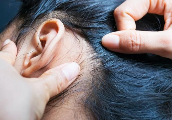 Itchy Scalp Causes & Treatments | Itching Remedies | Nizoral